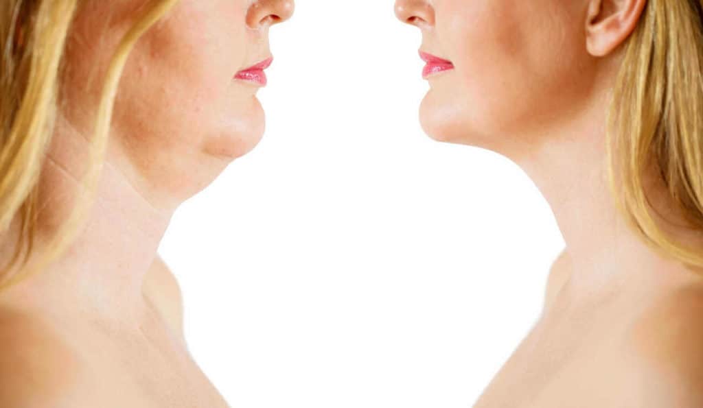 Double Chin treatment Beaconsfield before and after results