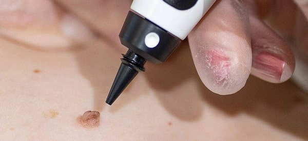 After Skin Tag Removal Beaconsfield