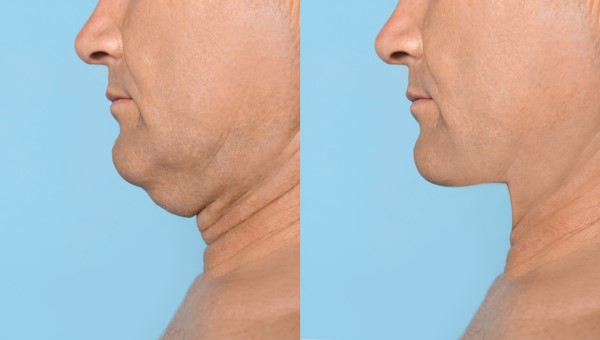 Which Non-Surgical Treatments Work Best for Jowls and Loose Skin Beaconsfield?