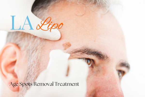 What Are the Most Effective Treatments for Age Spots Beaconsfield?