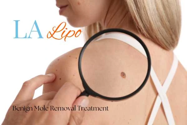 Woman having her inspection of blemish before mole removal Beaconsfield