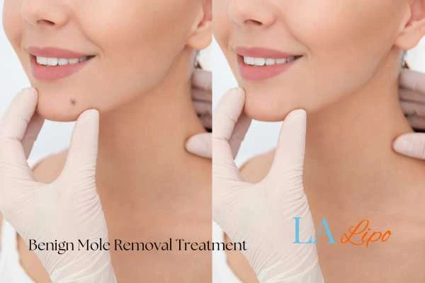 Before and after mole removal Beaconsfield treatment
