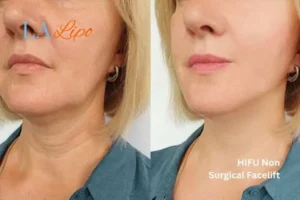 hi-fu for wrinkles Beaconsfield before and after results