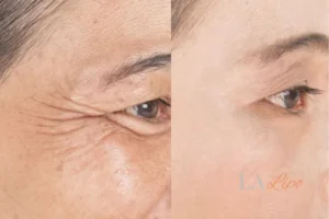 Before and after results of woman - HI-fu wrinkles reduction treatment Beaconsfield