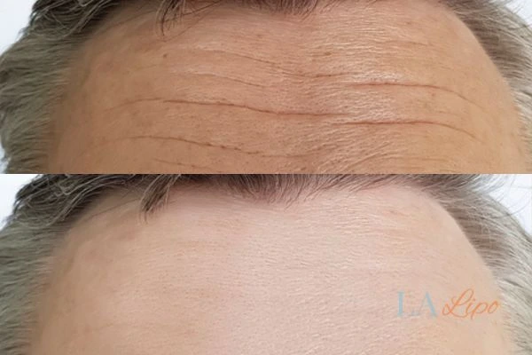 results of HIFU Beaconsfield on mans forehead to help reduce lines and wrinkles