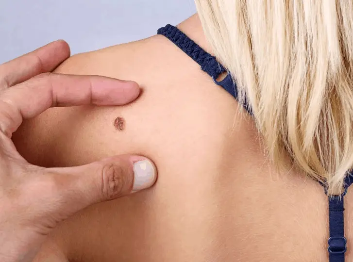 woman having mole removal Beaconsfield consultation before treatment.