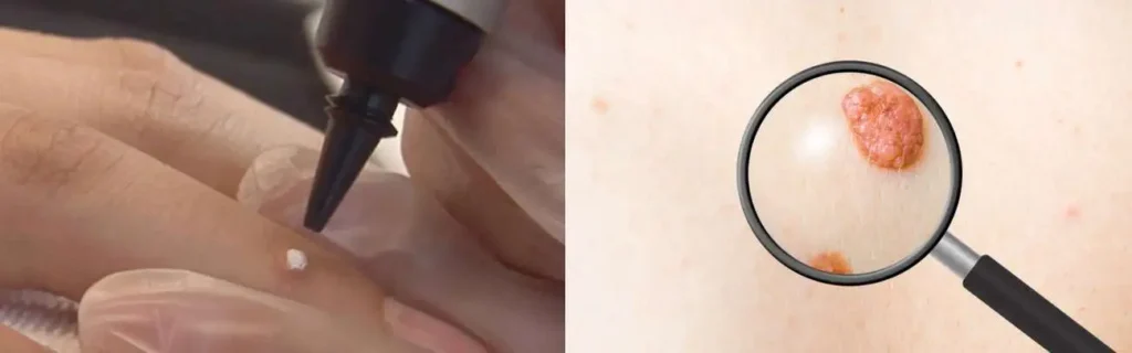 Cryopen for mole removal Beaconsfield - speak to our team today!