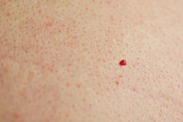 close up of a cherry angioma Beaconsfield