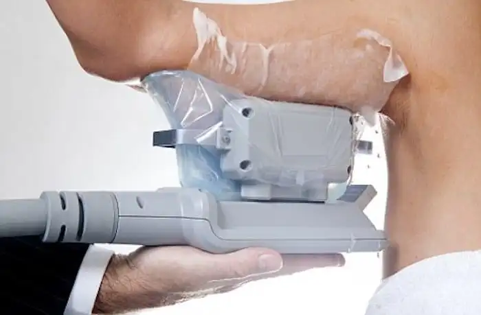 Picture of fat freezing Beaconsfield on the upper arms.
