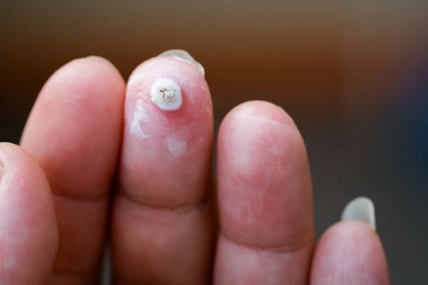 wart on person finger - cryotherapy to treat from LA LIPO Beaconsfield
