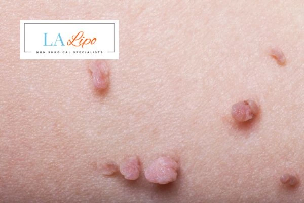 Does cryopen skin tag removal Beaconsfield hurt? Find out now call our team today!