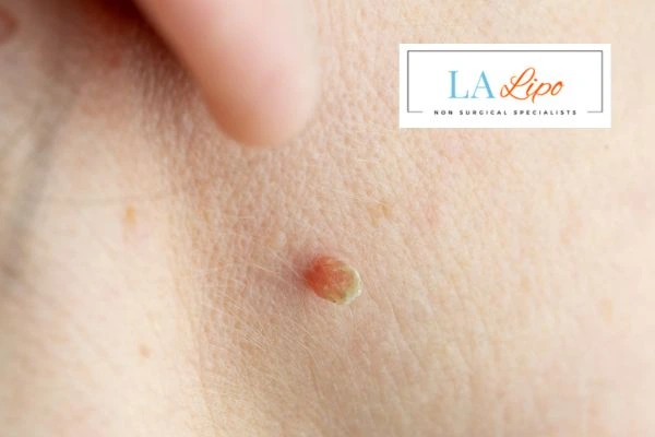 Book skin tag removal Beaconsfield today speak to our team now!