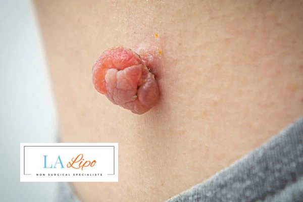 Interested in skin tag removal Beaconsfield? Concerned about the pain? Find out more today!