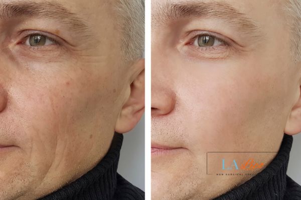 See the amazing results of Morpheus8 Treatment Beaconsfield!