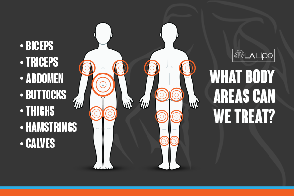 Diagram to show areas you can have LA-EMS Body Sculpting Treatment Beaconsfield