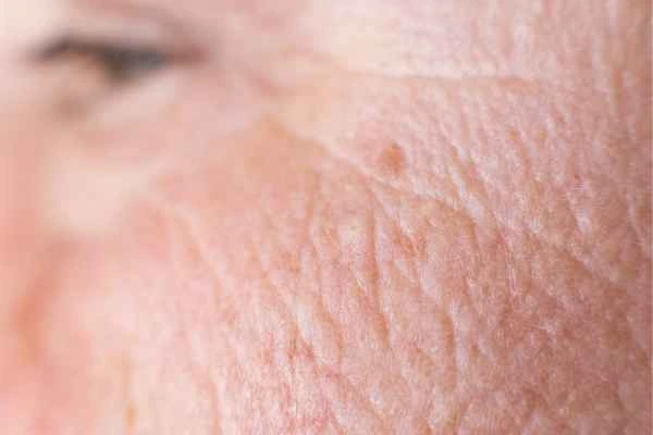 close up picture of a woman's face showing an age spot Beaconsfield