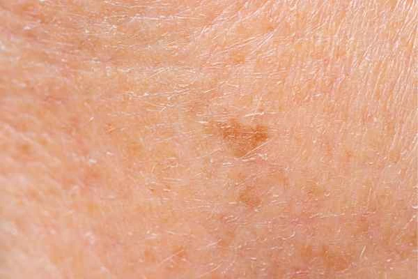 close up picture of age spots Beaconsfield
