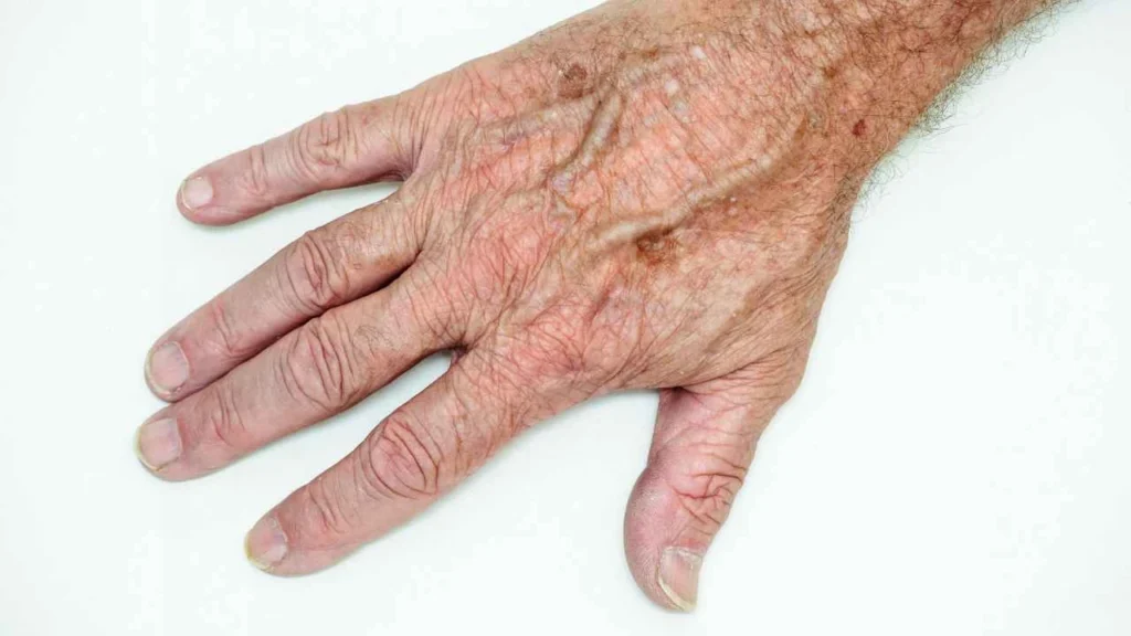 Male hand showing age spot Beaconsfield