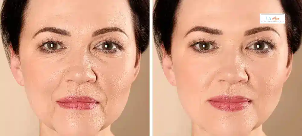 How Long Does It Take to See Results and How Long Do They Last Beaconsfield?