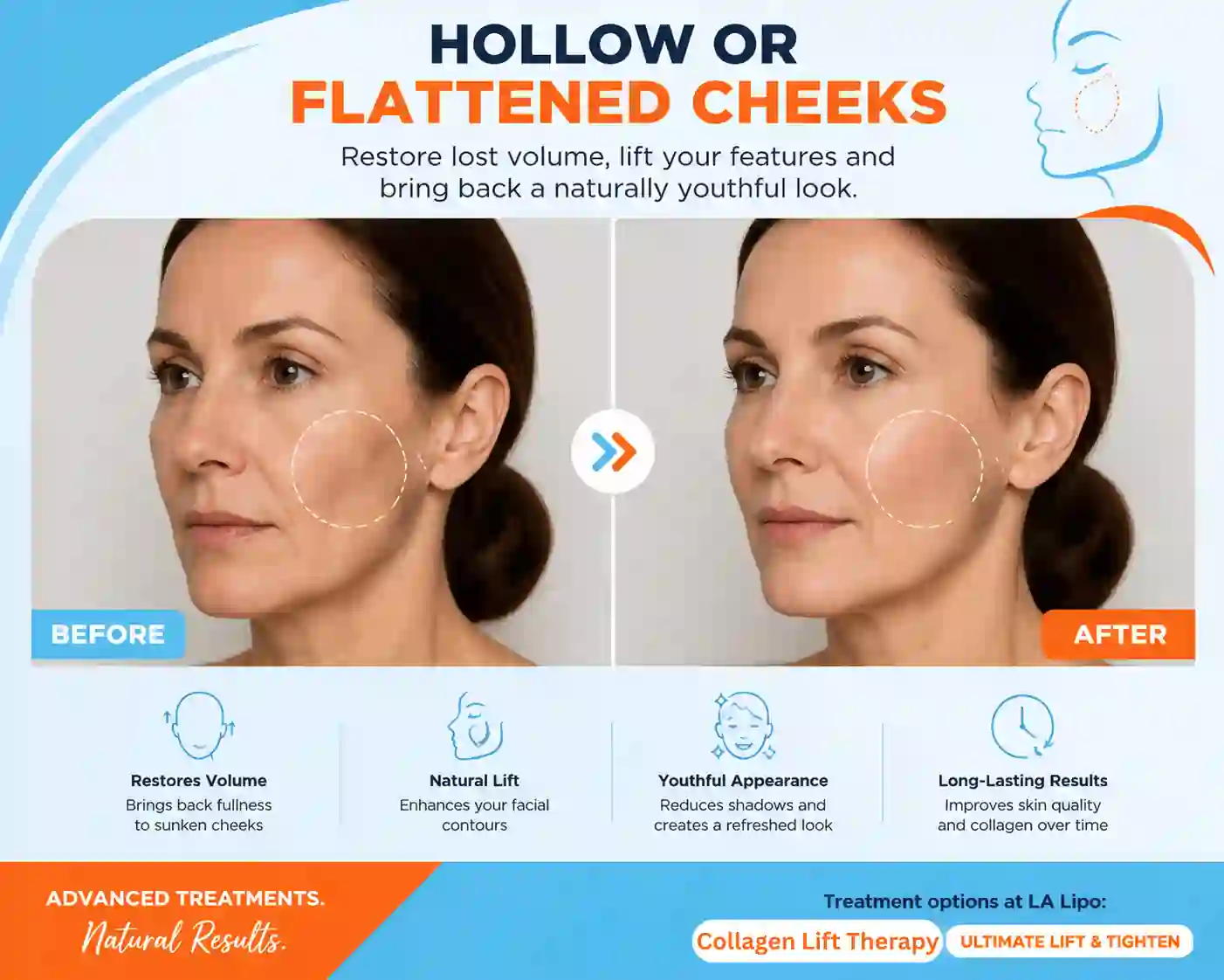 Sign #4: Hollow or Flattened Cheeks Beaconsfield