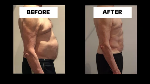 What Symptoms Can Diastasis Recti Cause in Men? Weak Core, Back Pain and Poor Posture Beaconsfield